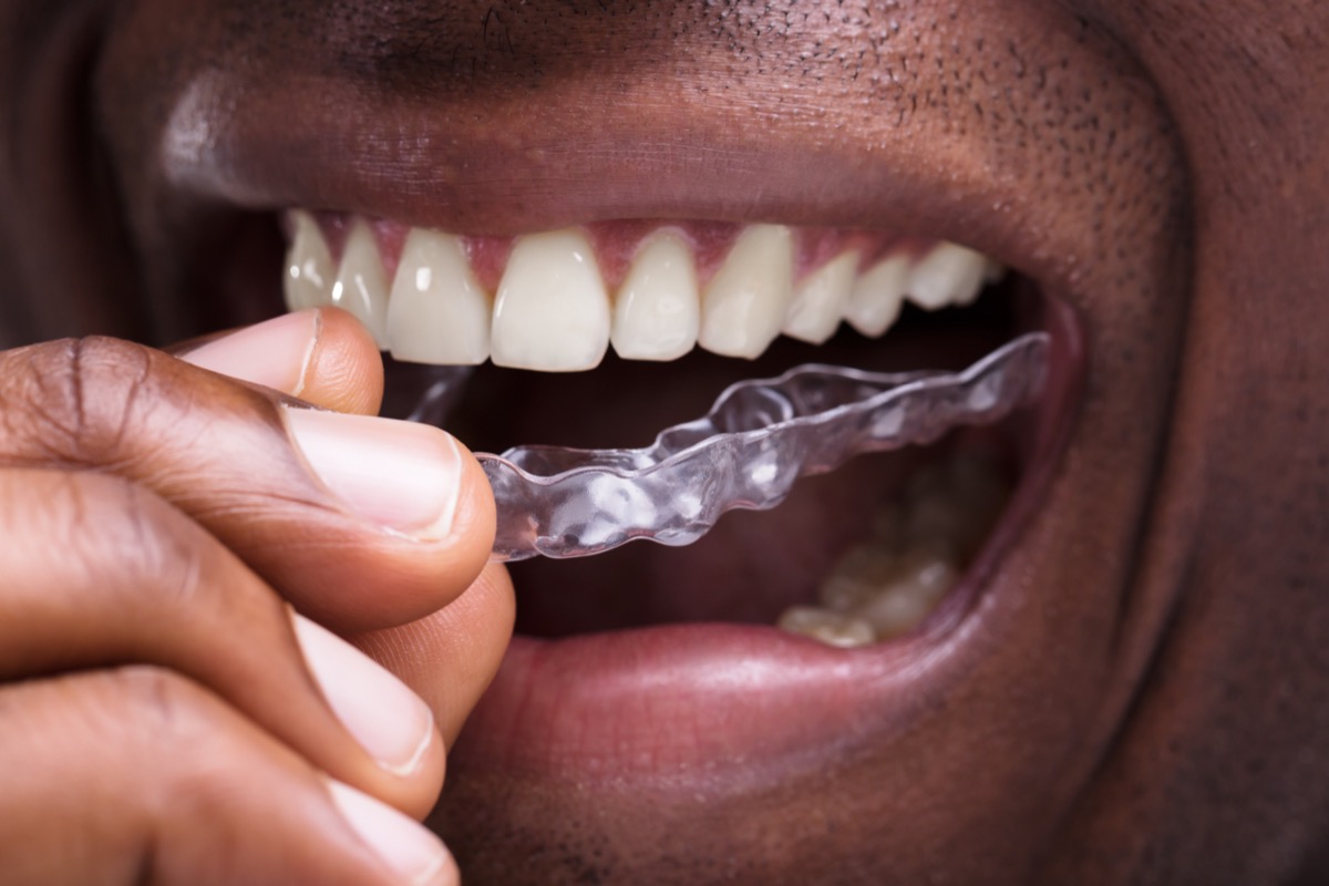 closeup of a man putting on invisalign