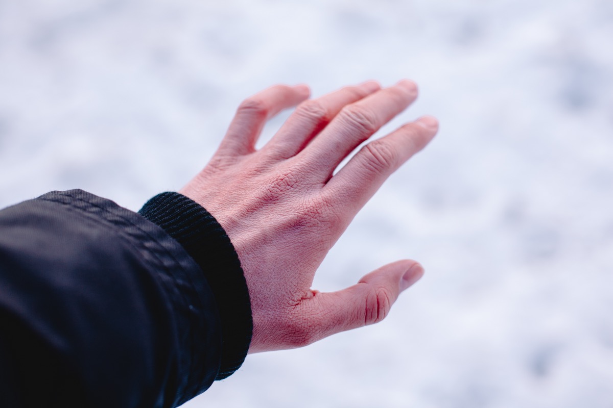frostbitten hand