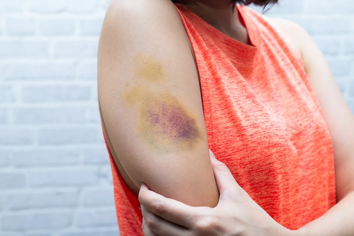 Bruise on a woman's arm
