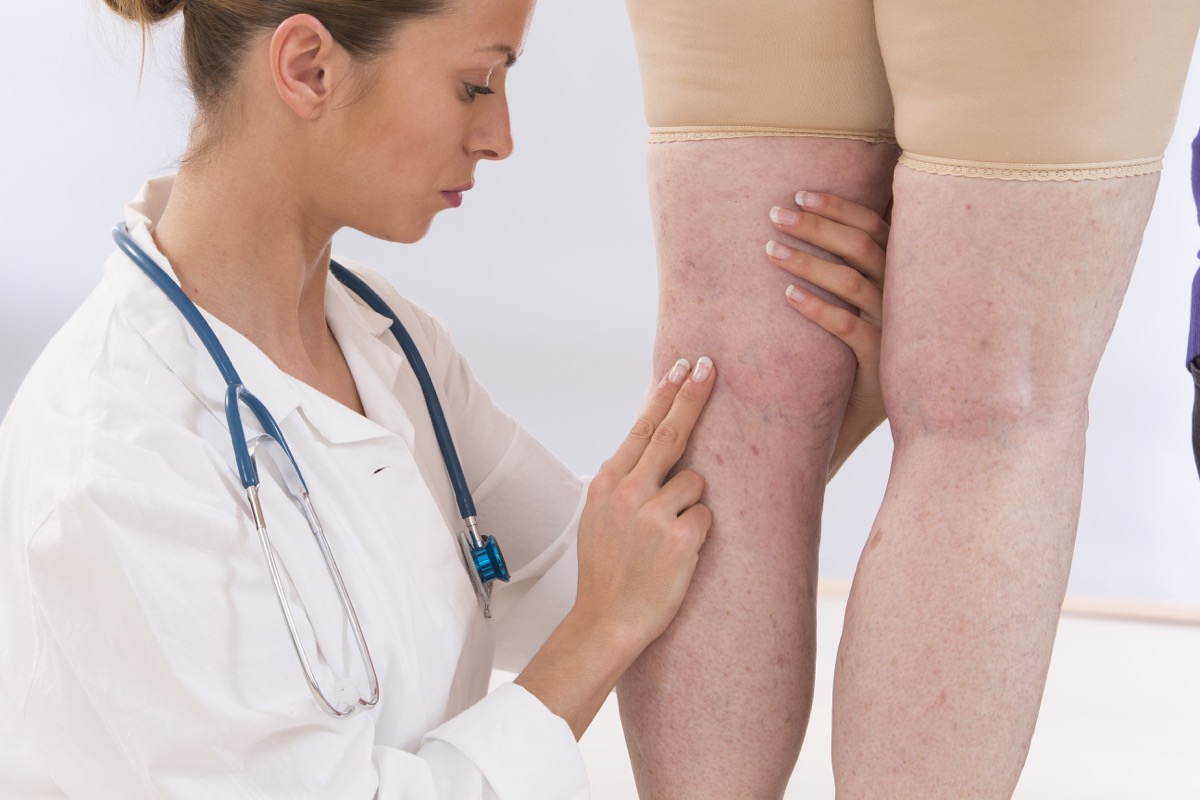 Doctor check a patient's swollen legs and veins