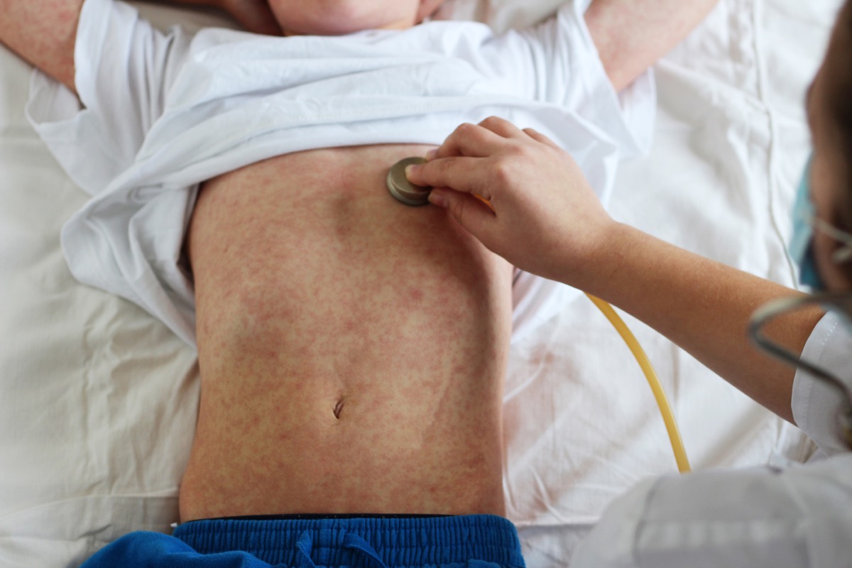 boy with measles rash all over his body