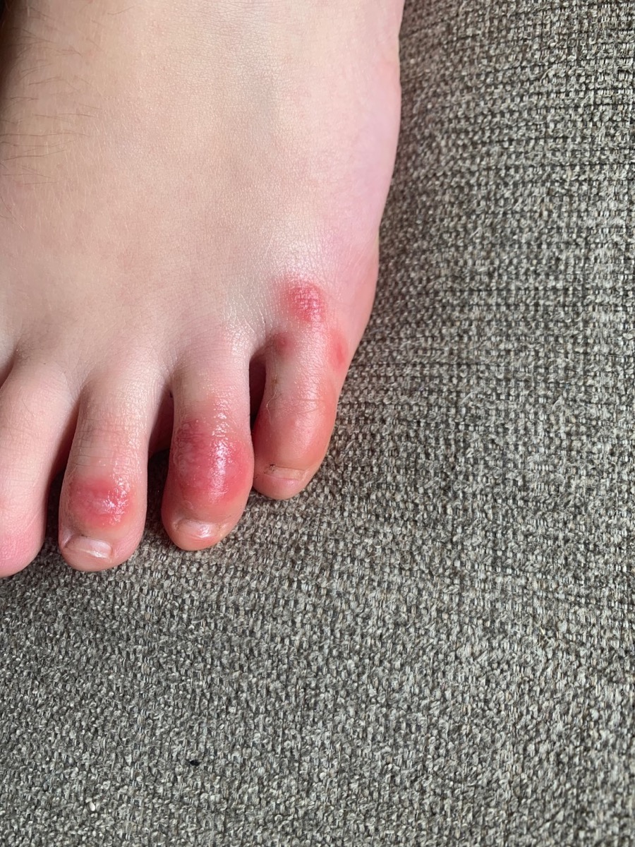 COVID toes coronavirus symptom
