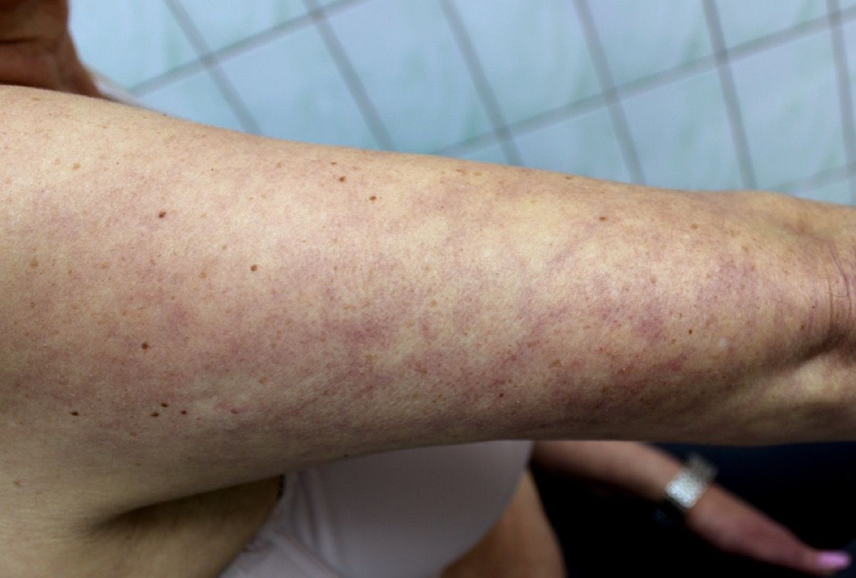 causes of rash purple