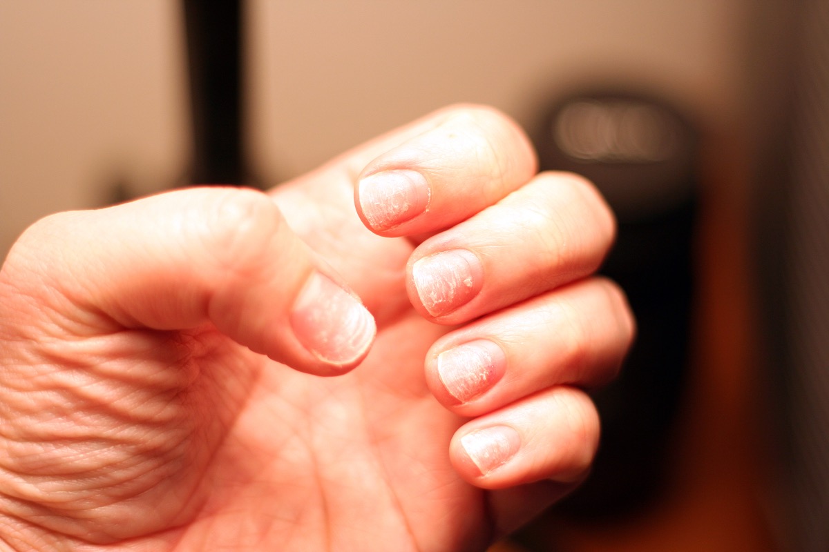 Brittle nails