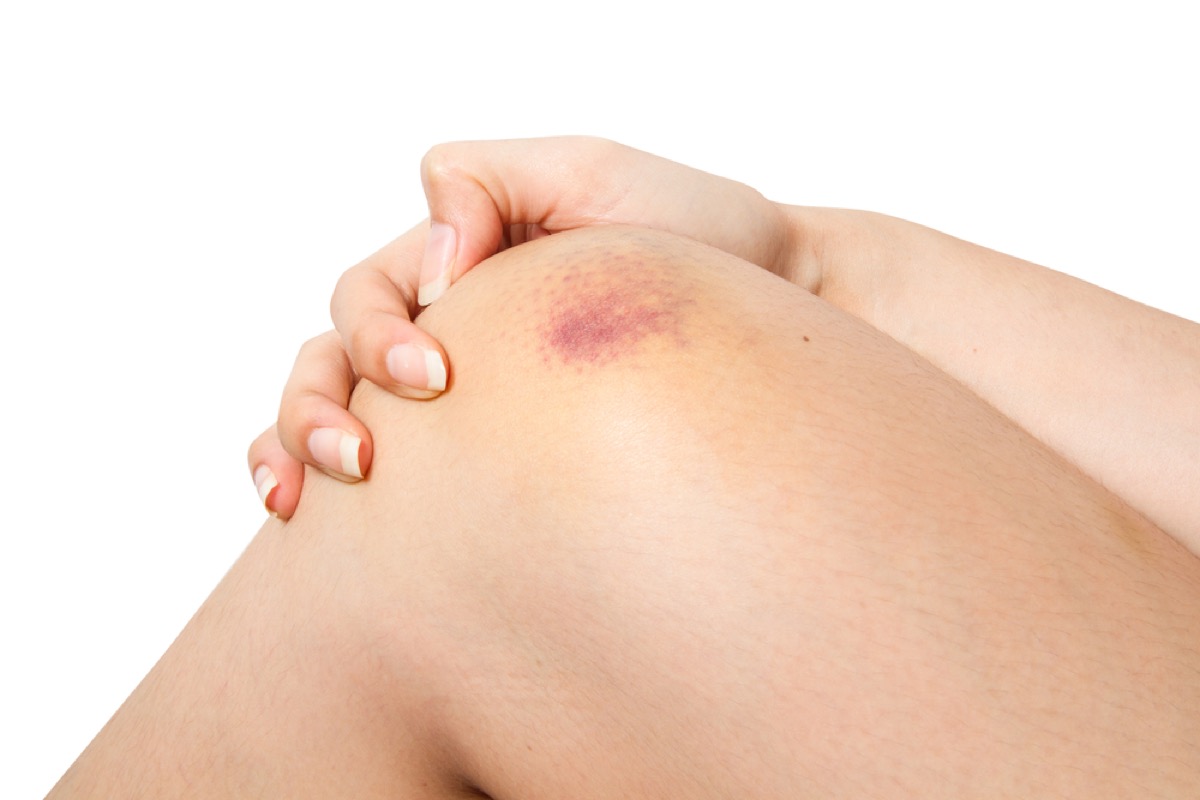 petechiae on knee due to bruise