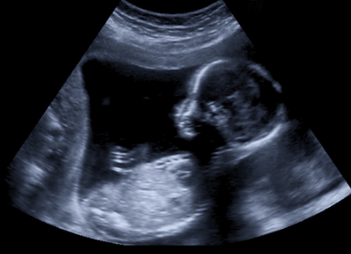 Sonogram of baby in womb