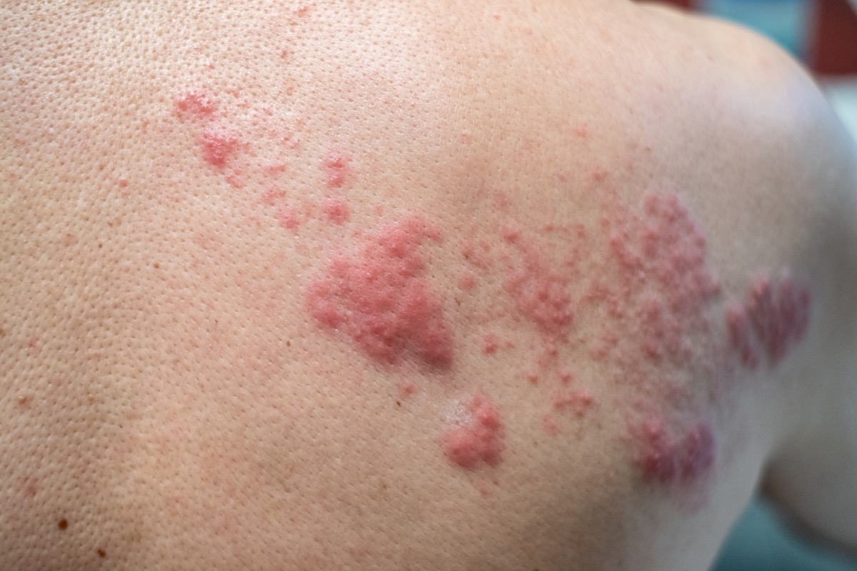 Chickenpox-like rash