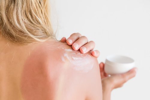 On woman's back skin smears cream after sun burn.