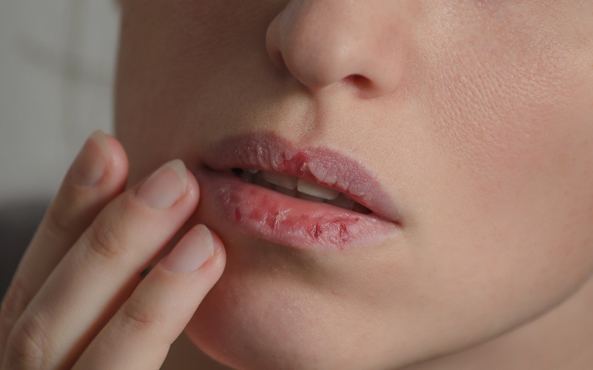 Woman with dry cracking lips