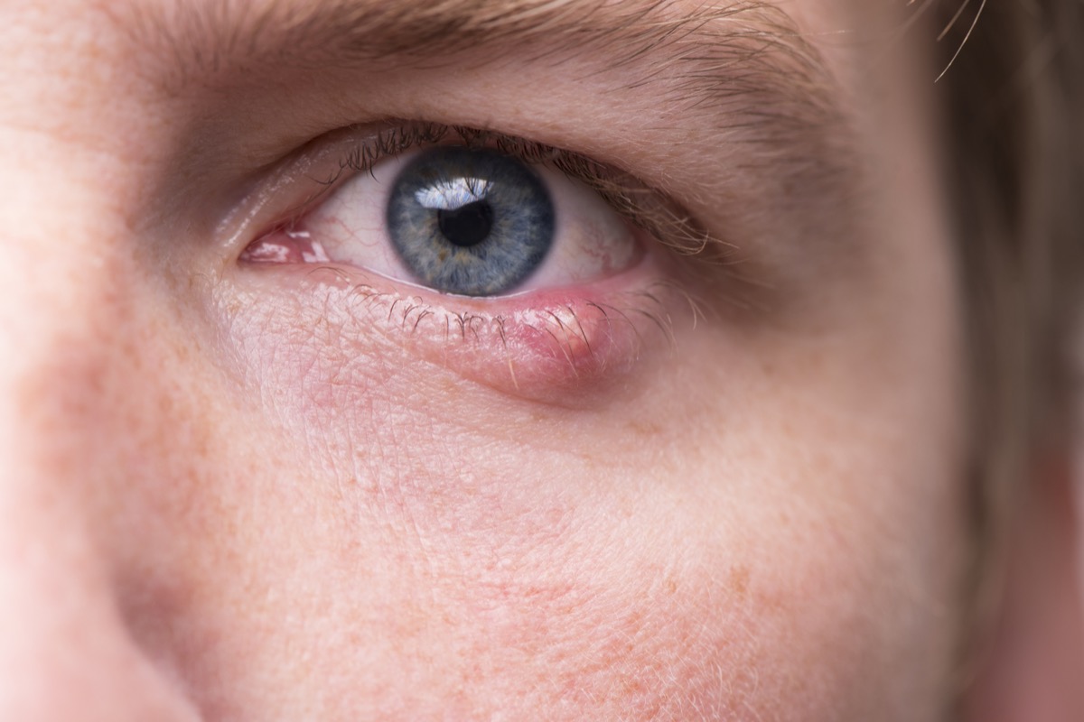 Close up of a man's eye with a bacterial infection of an oil gland in the lower eyelid.
