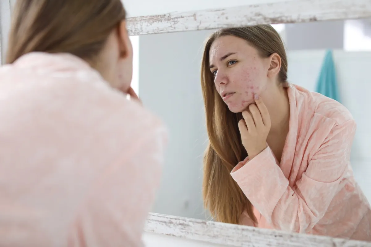 Woman looking at her acne in the mirror