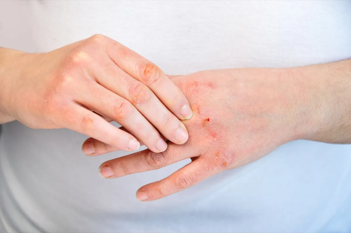 Dry hands from over-moistrurizing