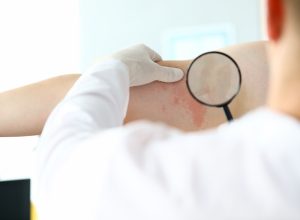 Dermatologist examines a red rash on a patient's skin