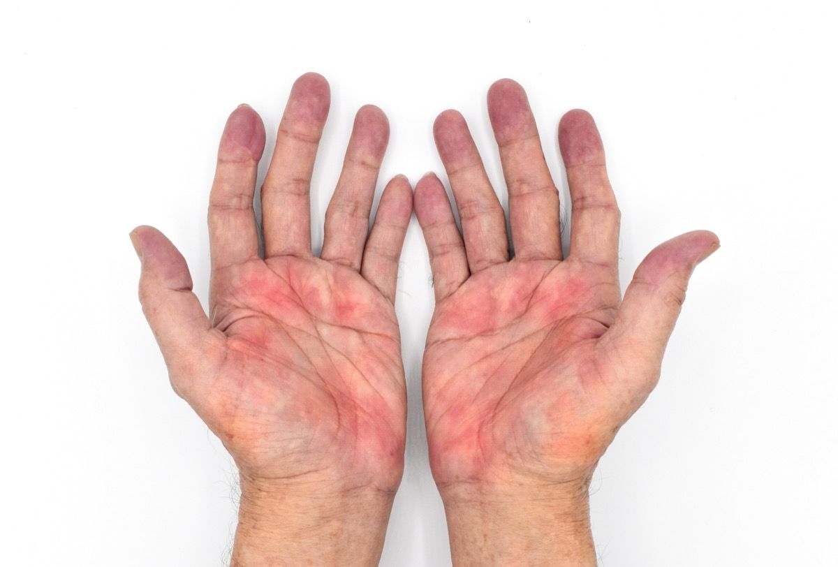 https://bestlifeonline.com/wp-content/uploads/sites/3/2021/03/palmar-erythema.jpg?quality=82&strip=all