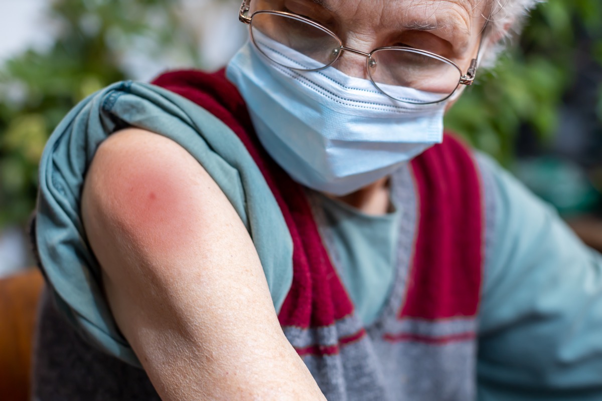 vaccine rash, senior woman arm, light blue face mask