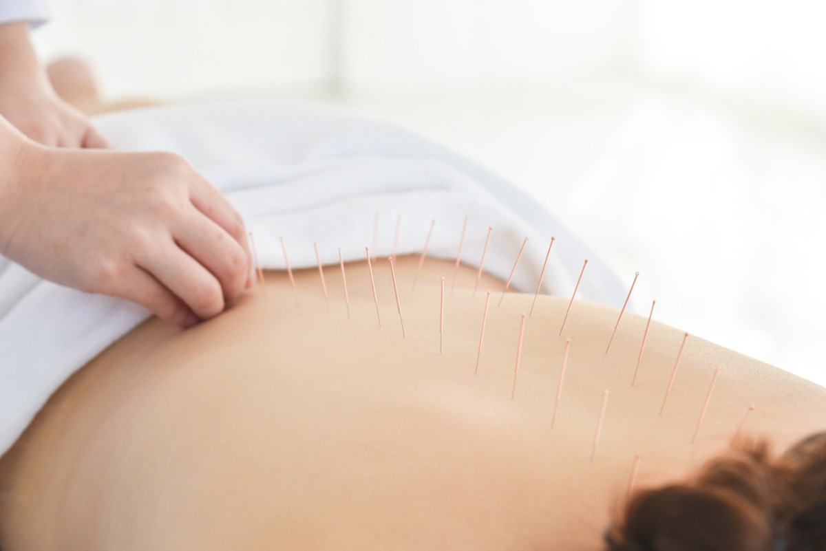 Woman getting acupuncture on back