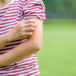Woman itching mosquito bites