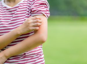 Woman itching mosquito bites