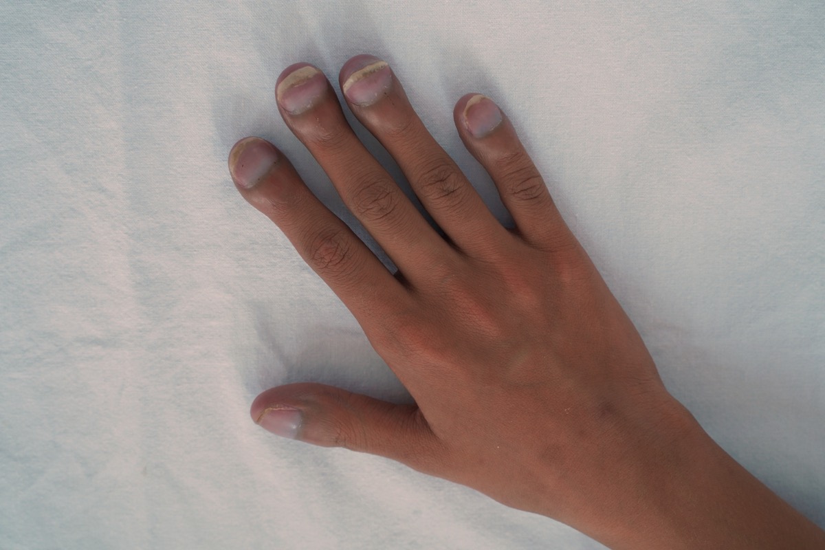 patients with big fingertips, clubbing