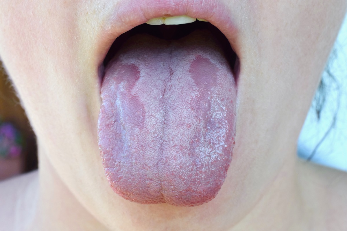 How To Get Rid Of White Tongue After Covid