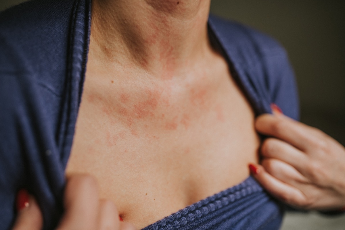 Woman in purple blouse show off manifestation of skin allergy on her chest.