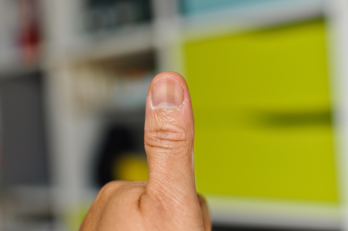 thumb with a streak on nail