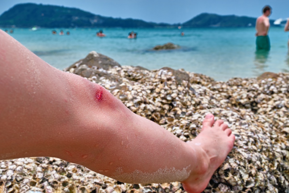 Cut knee on beach