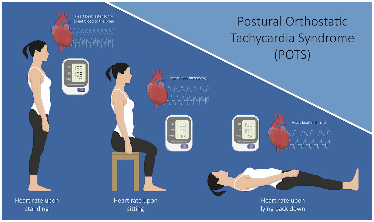 A graphic showing how POTS can affect heart rate