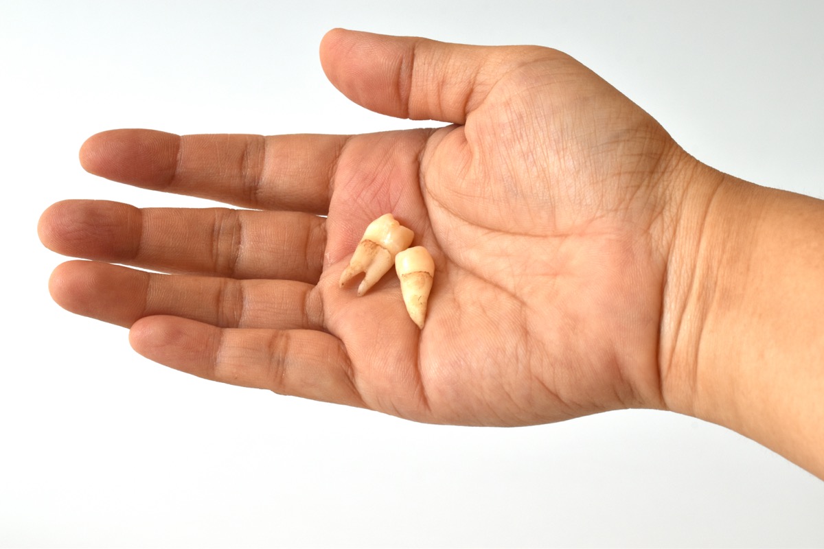 tooth in a hand after extraction on white background, lost your tooth
