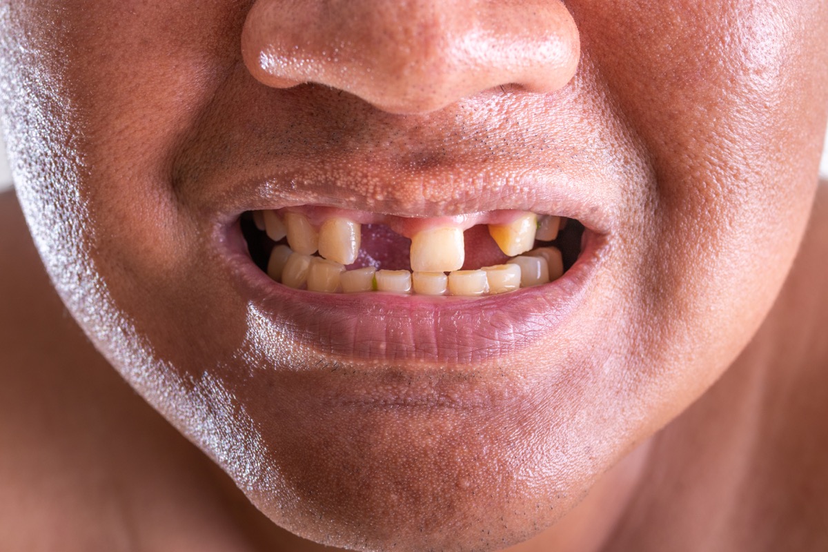 Close-up of young man with a teeth broken.