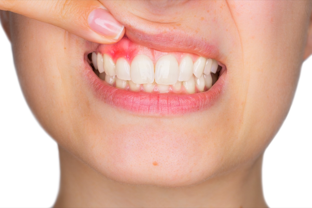 Closeup of woman with gum disease