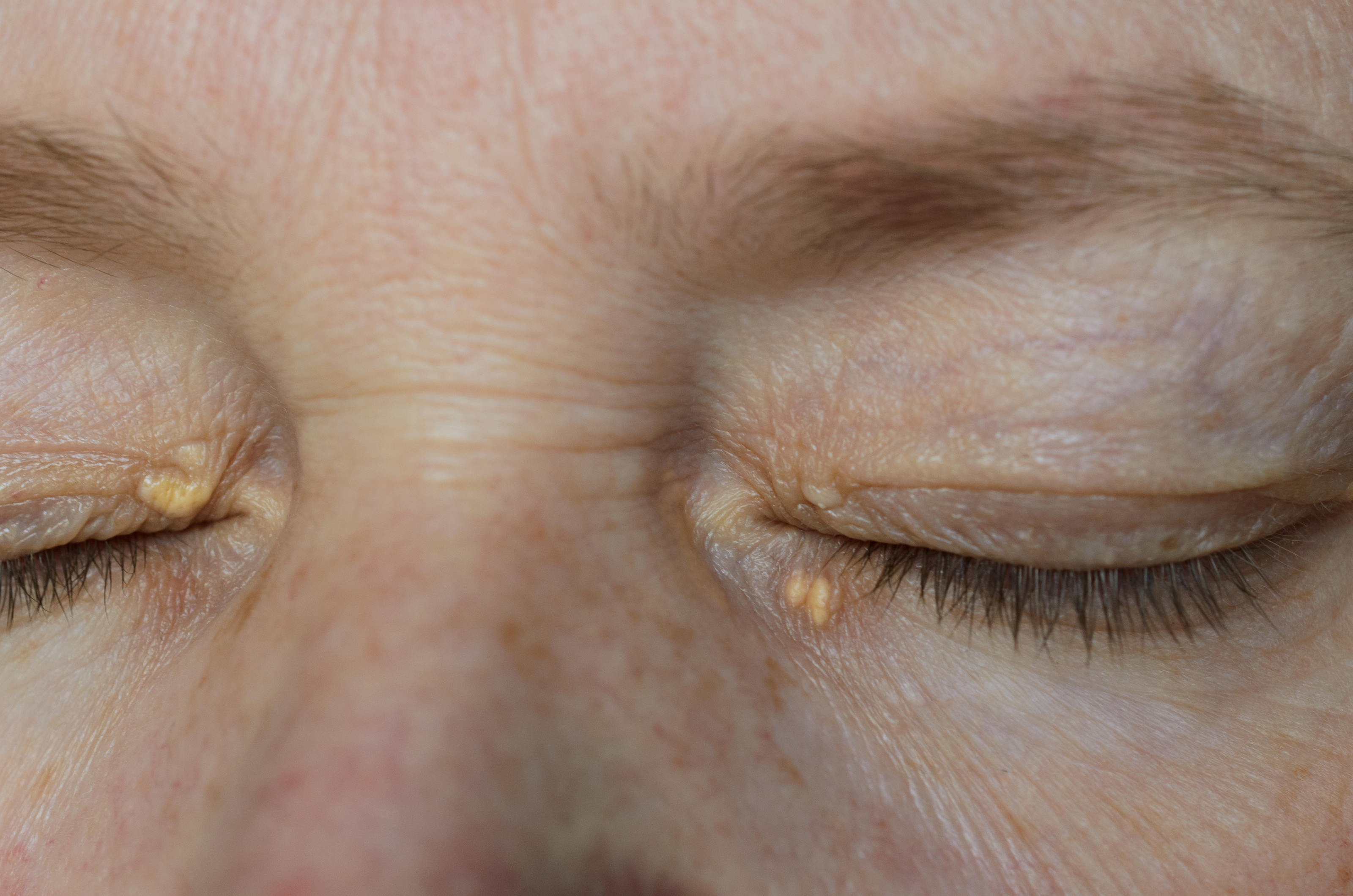 Close up of woman's eyes with xanthelasma