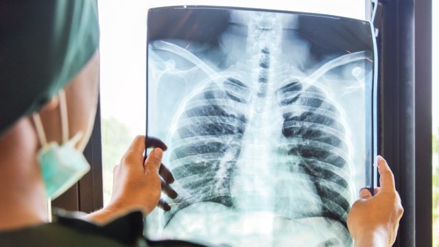 Doctor looking at lung x-ray