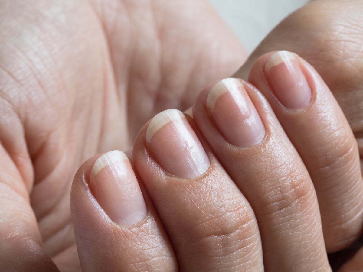Having Pitted Fingernails Can Signal Autoimmune Conditions — Best Life