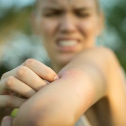 close up of a red mosquito bite on a person's arm, rubbing and scratching it outdoor in the park.