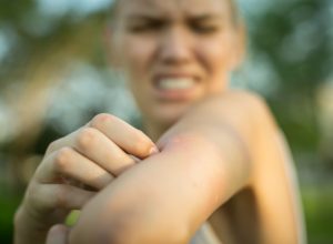 close up of a red mosquito bite on a person's arm, rubbing and scratching it outdoor in the park.