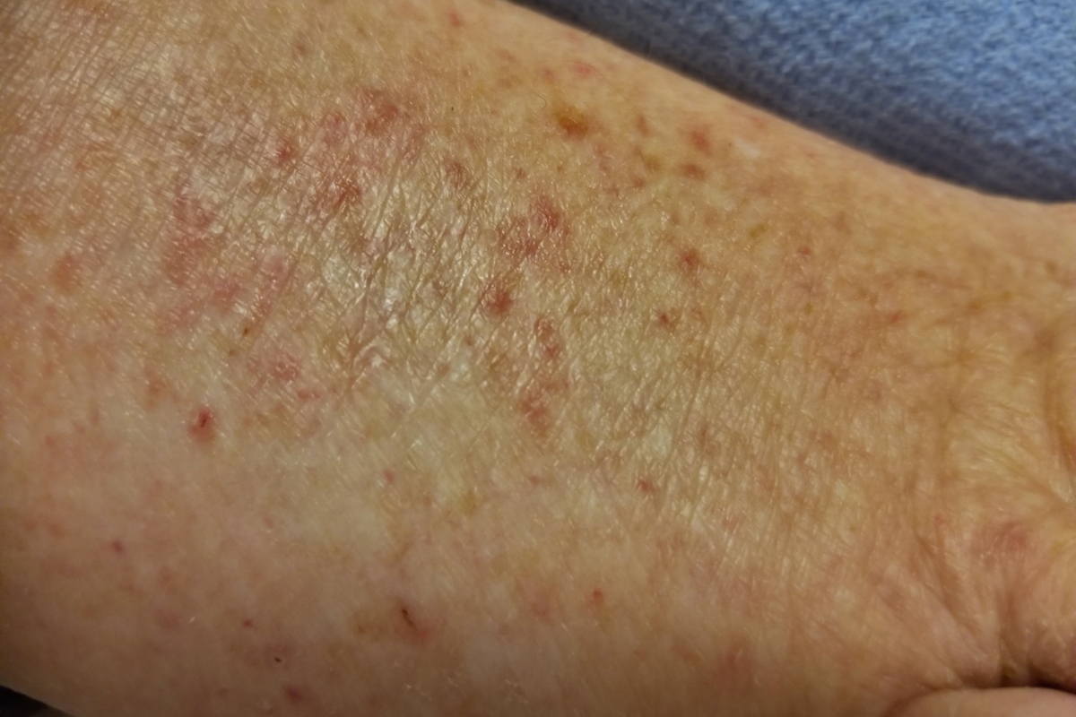 Rote Flecken auf weißer Haut aufgrund von Hörproblemen