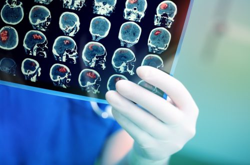 Evaluare PET scanare cerebrală