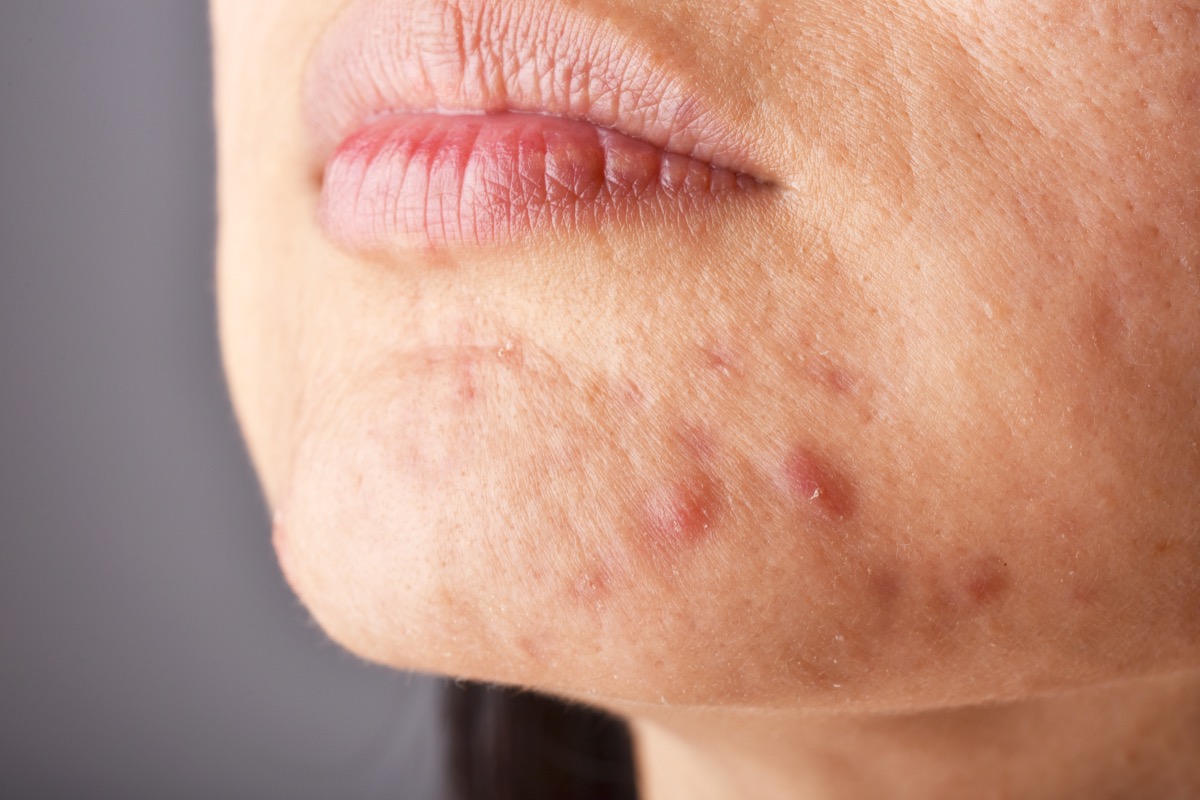 Close-up of a Woman's Face with Acne