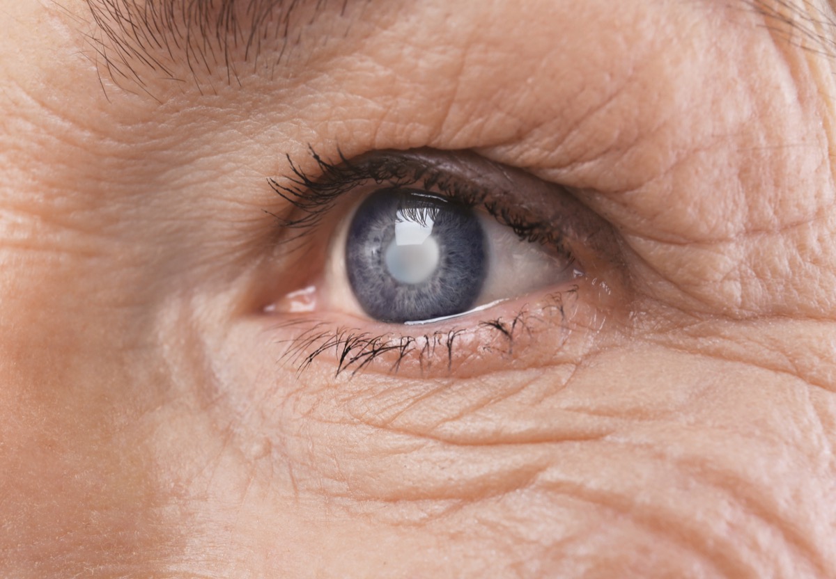 Prim-plan al unui ochi cu cataractă