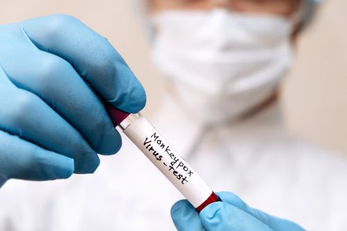 A lab technician holding a blood sample for a monkeypox test