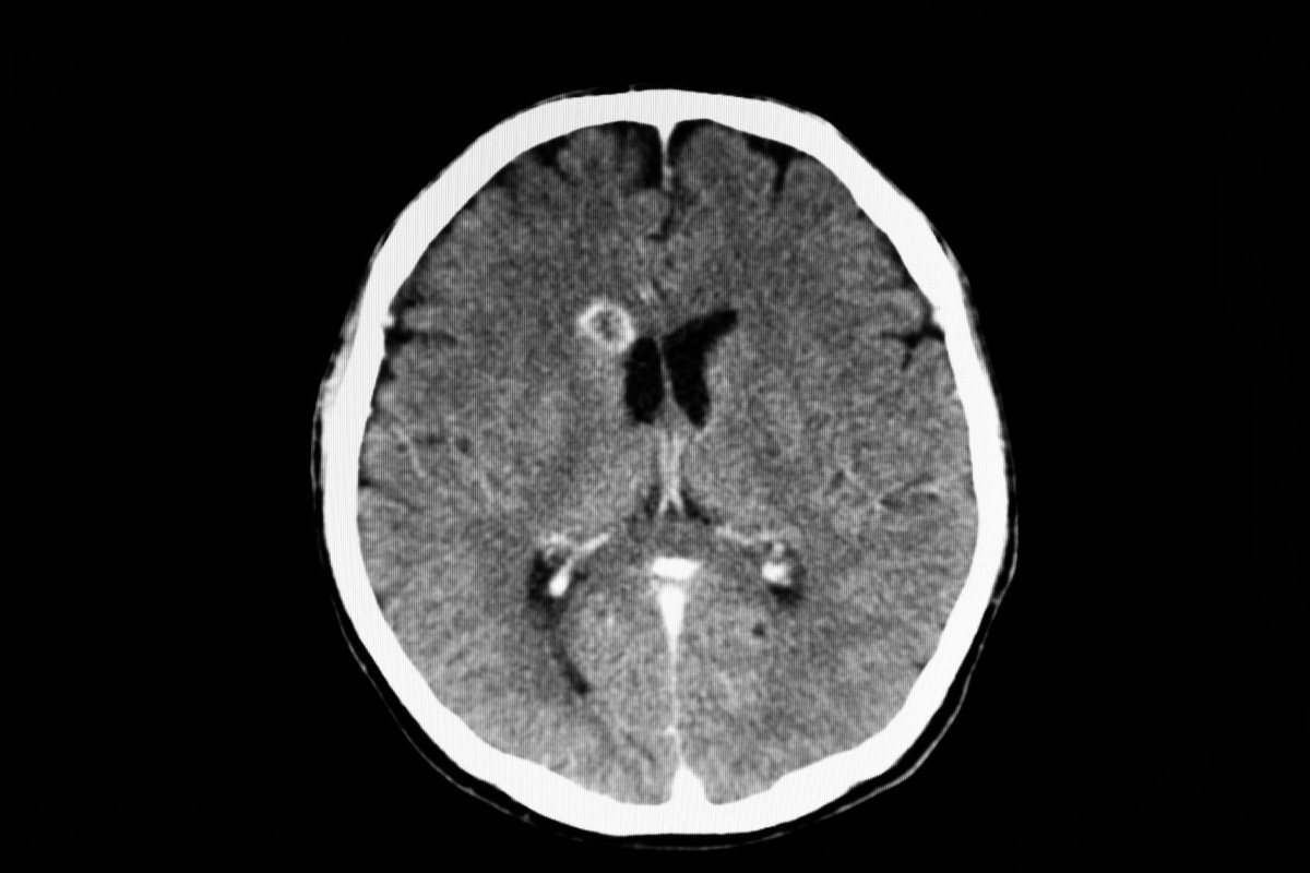 Αξονική τομογραφία εγκεφάλου ασθενούς που εμφανίζει βλάβη του δακτυλίου ή απόστημα στον δεξιό κερκοφόρο πυρήνα από κυστικέρκωση