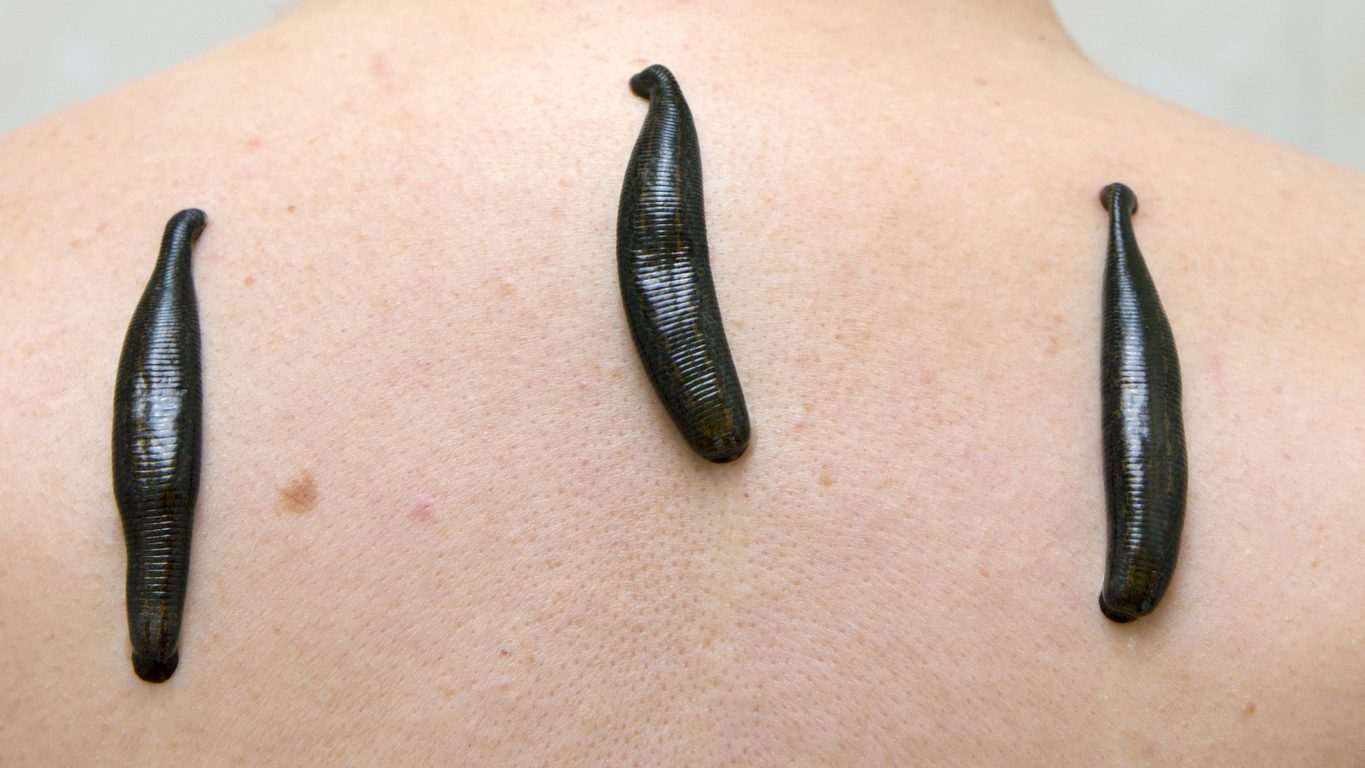 Leeches on a person's back.
