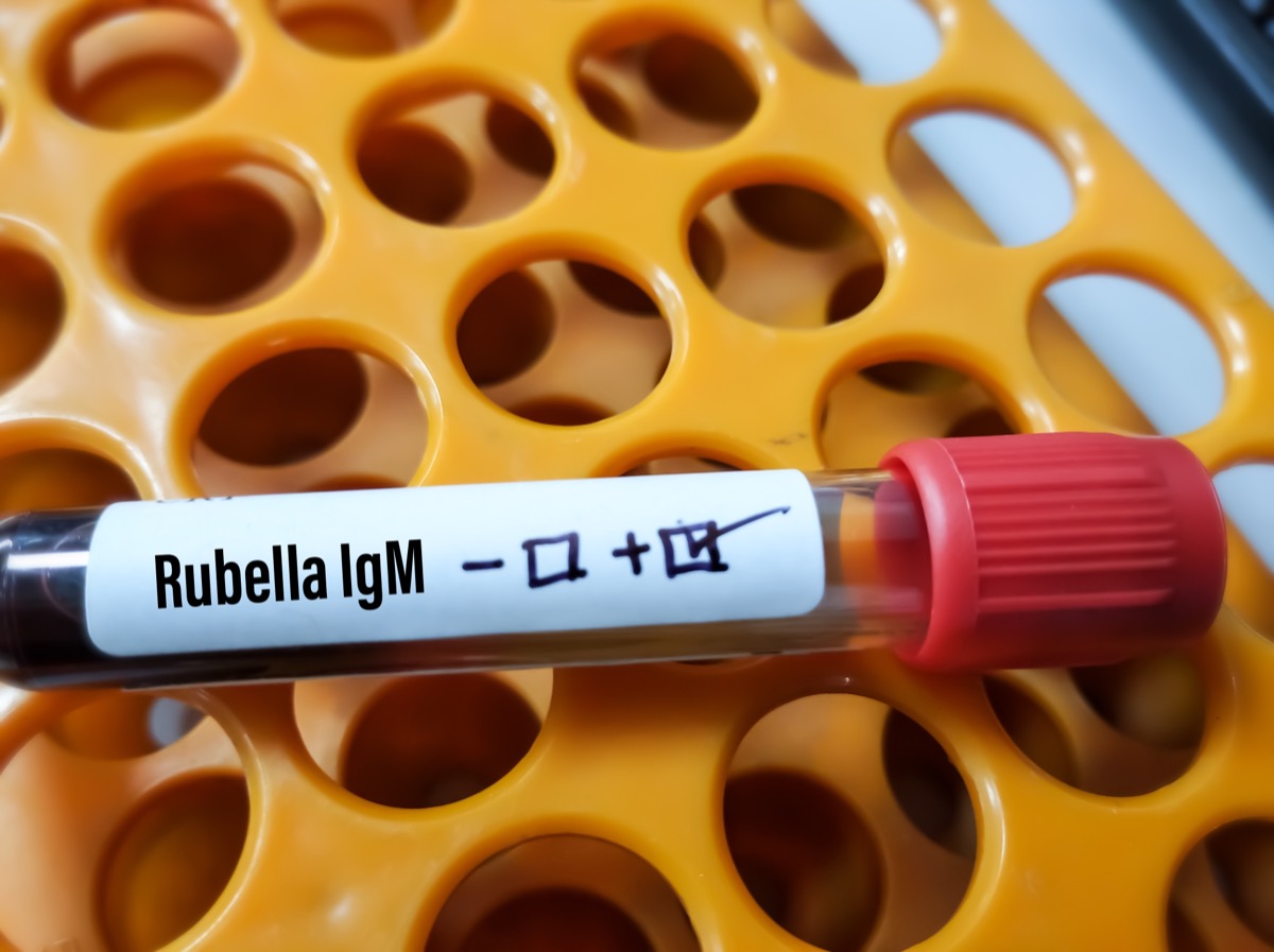 Blood sample for Rubella IgM test, positive result at laboratory.