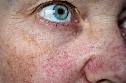 Woman with spider veins on her face