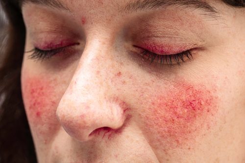Rosacea on Young Woman