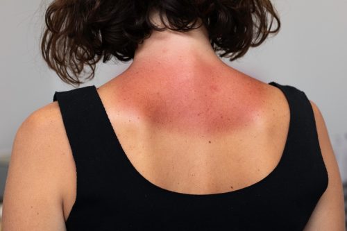 Sunburnt Woman's Neck