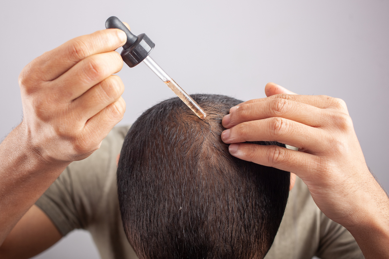 Man using minoxidil on scalp to treat hair loss.