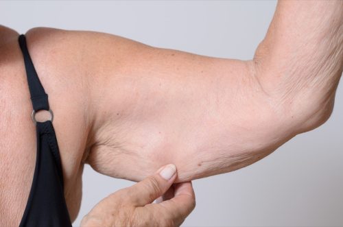 Muscle Loss in Woman's Arm