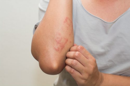 close up of woman scratching itchy arm with rash